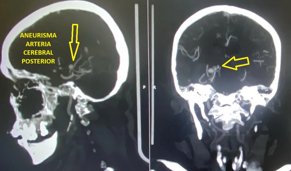 Angiotomografía cerebral utilizada en evaluación neurovascular