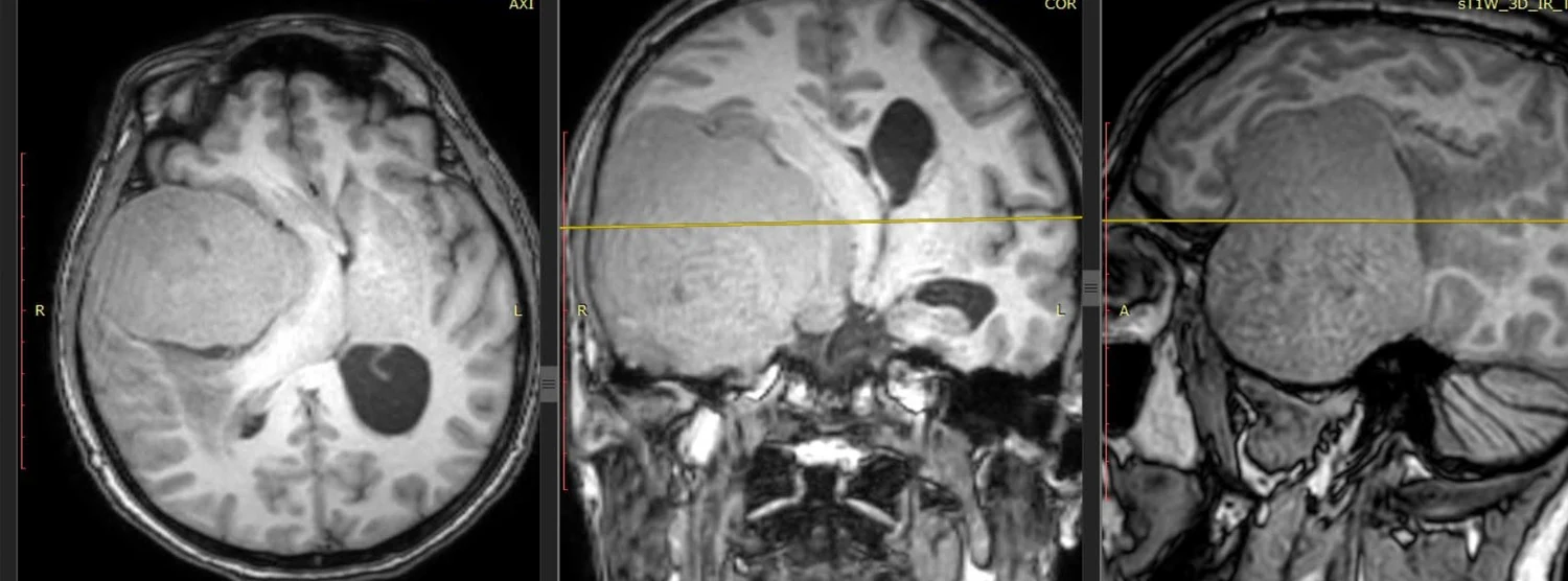 Resonancia cerebral multiplanar anonimizada